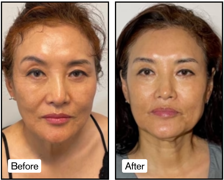 Decrease in Wrinkles & Crows Feet