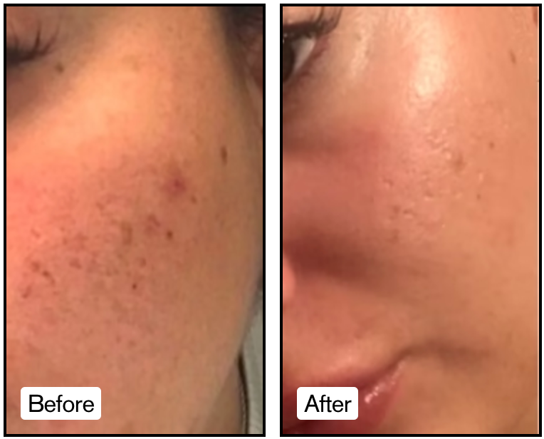 Reduction of Acne Scars